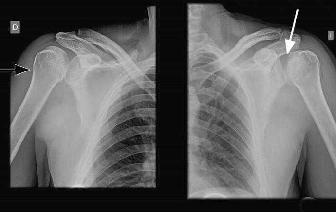 RX, hombros comparativos